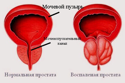Prostatitis und männliche Unfruchtbarkeit Anatomie